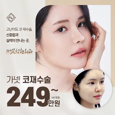 고난이도 가넷 코 재수술 이벤트 썸네일 이미지