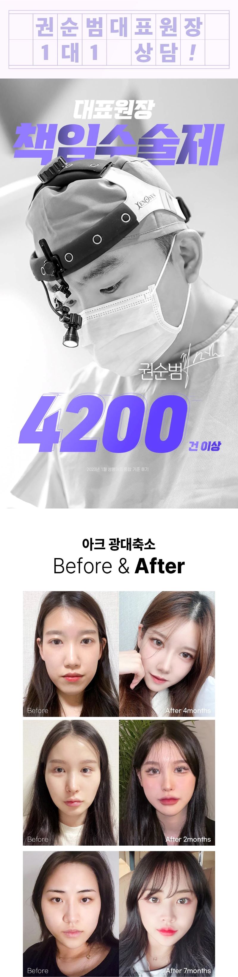 아크성형외과의원 아크_광대축소 이벤트, 시술 상세 이미지