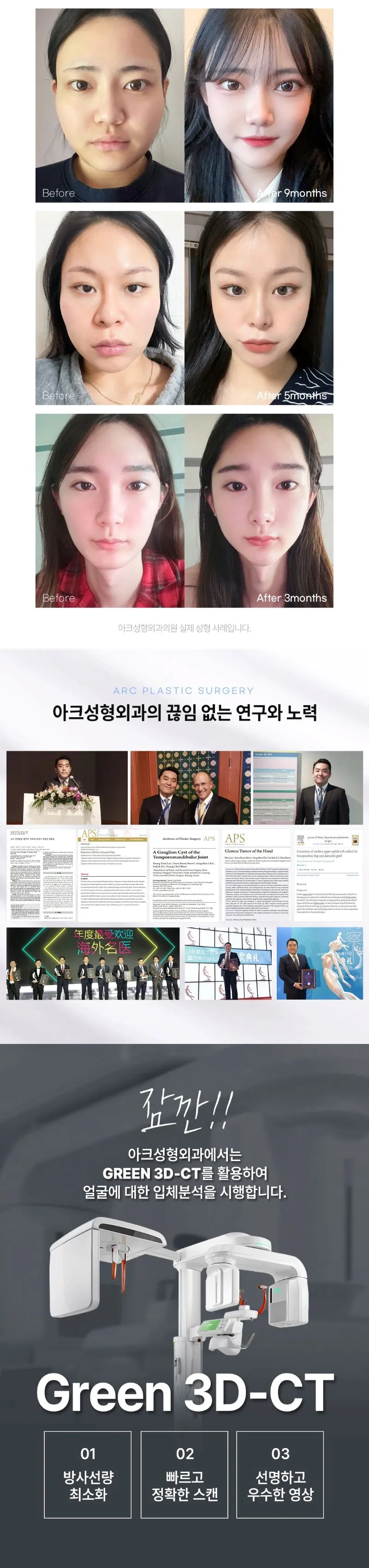 아크성형외과의원 아크_광대축소 이벤트, 시술 상세 이미지