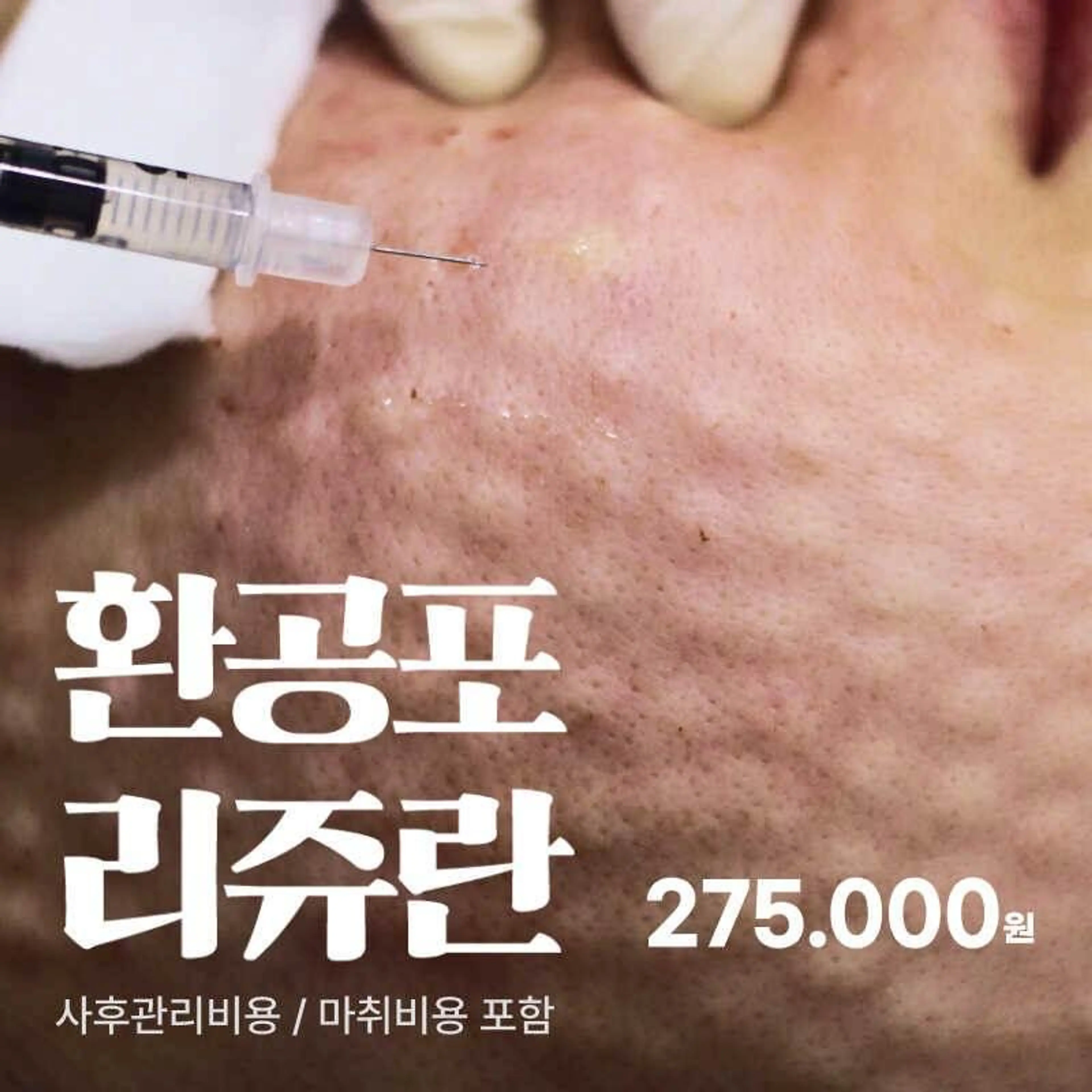 환공포리쥬란 2cc+피부진단+진정관리