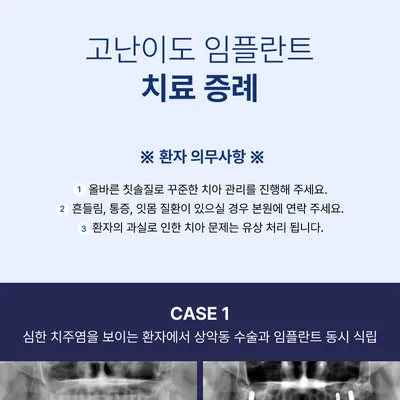 이수스마트치과의원 오스템 CA임플란트 이벤트, 시술 상세 이미지