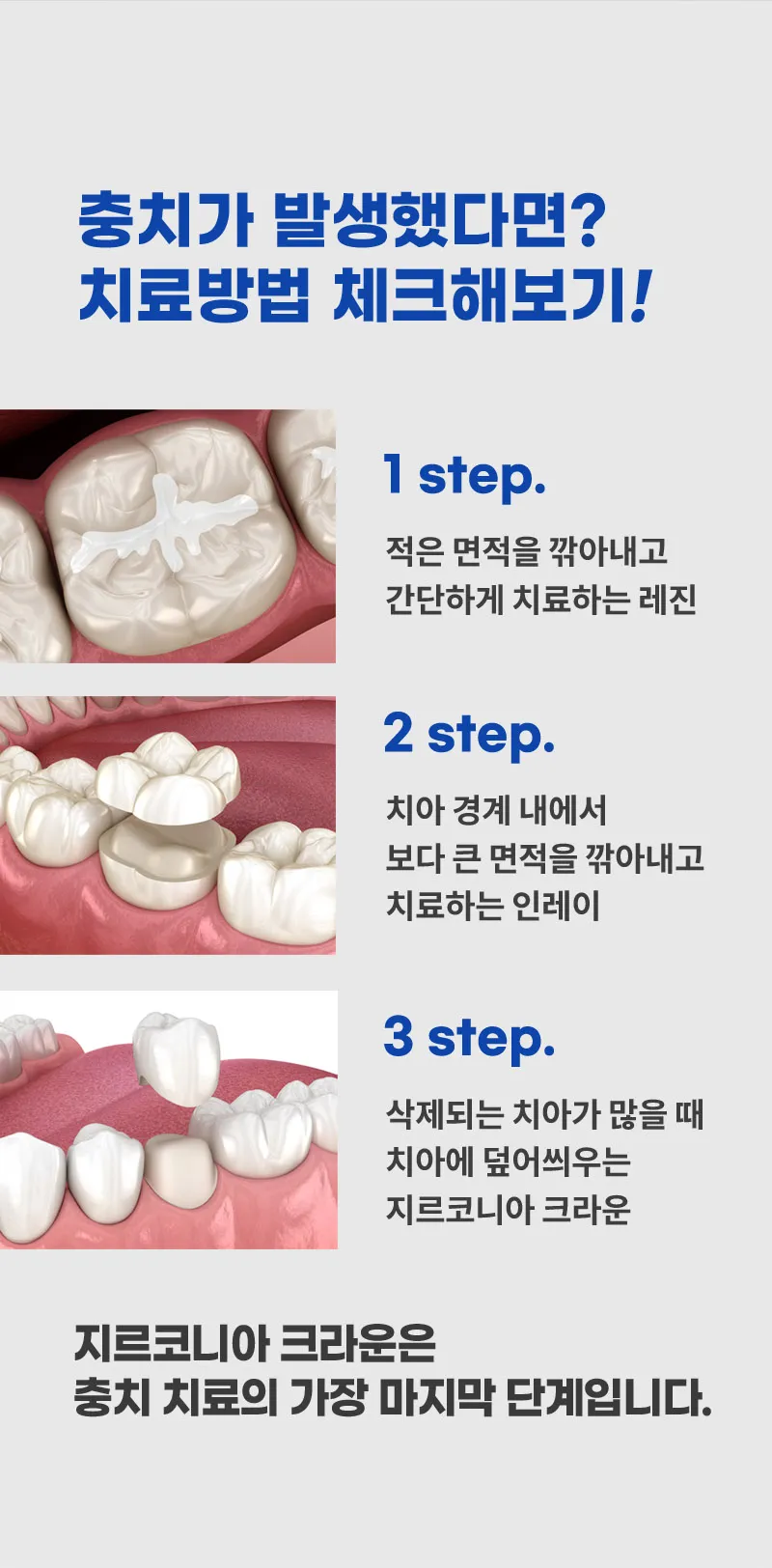 이수스마트치과의원 지르코니아 크라운 충치치료  이벤트, 시술 상세 이미지