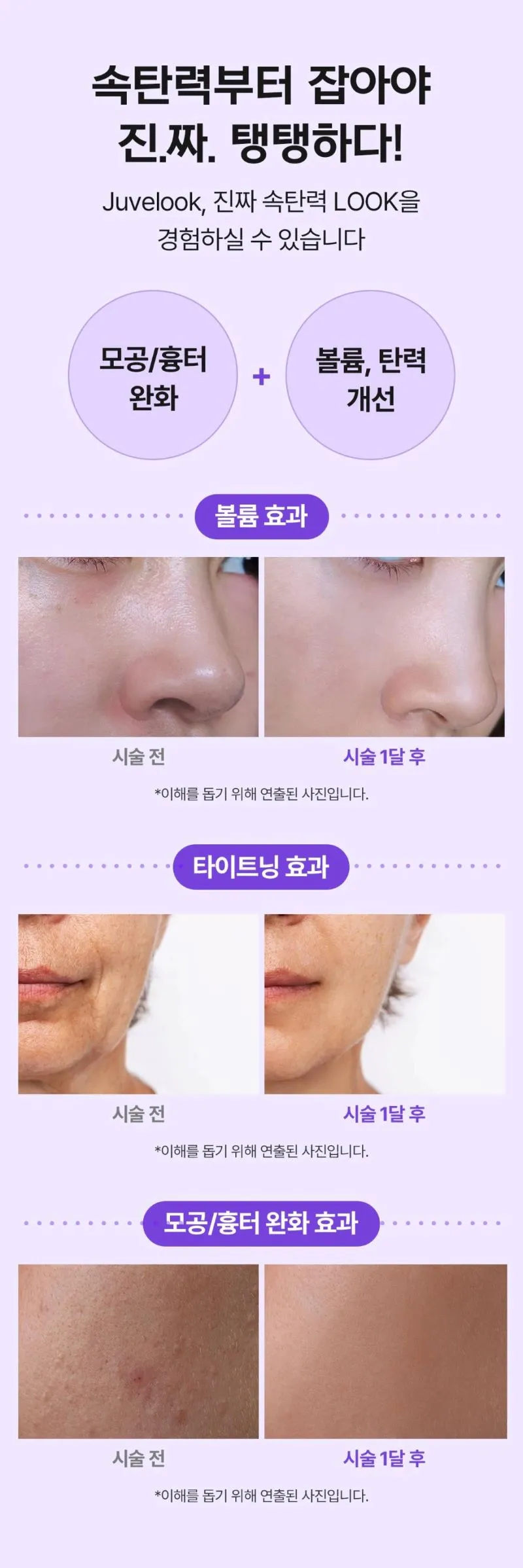 본연성형외과의원 본연_쥬베룩볼륨&쥬베룩 이벤트, 시술 상세 이미지