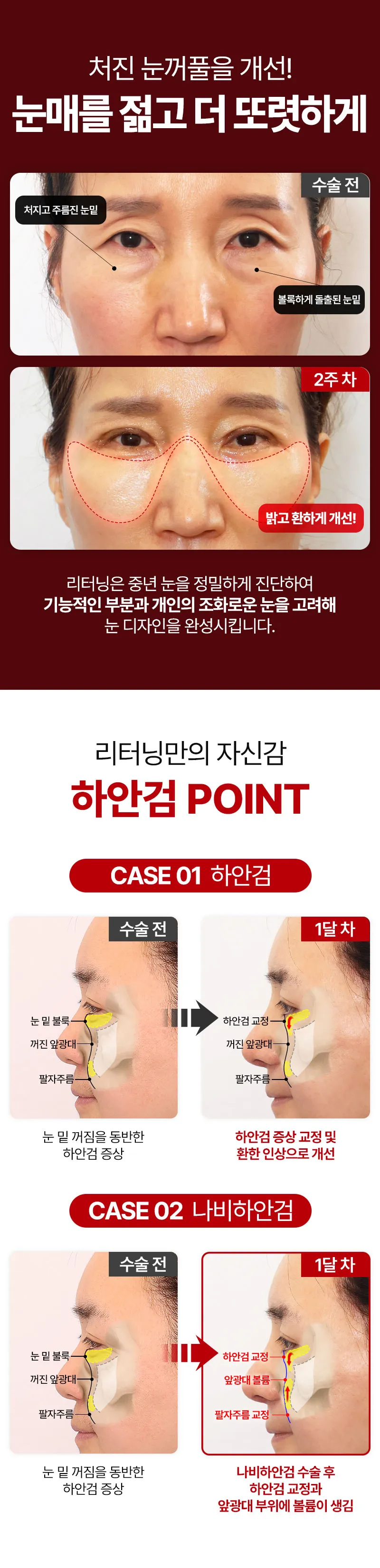 리터닝성형외과 리터닝 하안검 이벤트, 시술 상세 이미지