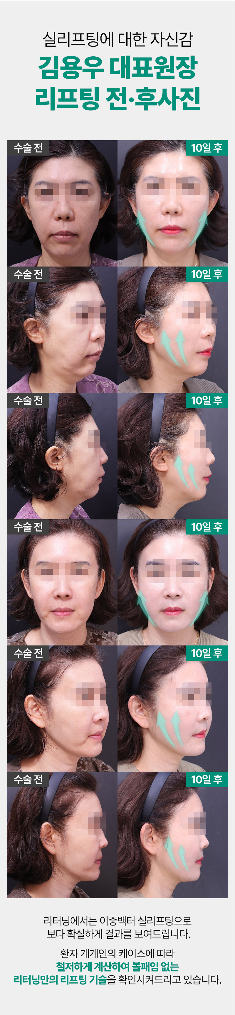 리터닝성형외과  리터닝 민트실리프팅 이벤트, 시술 상세 이미지