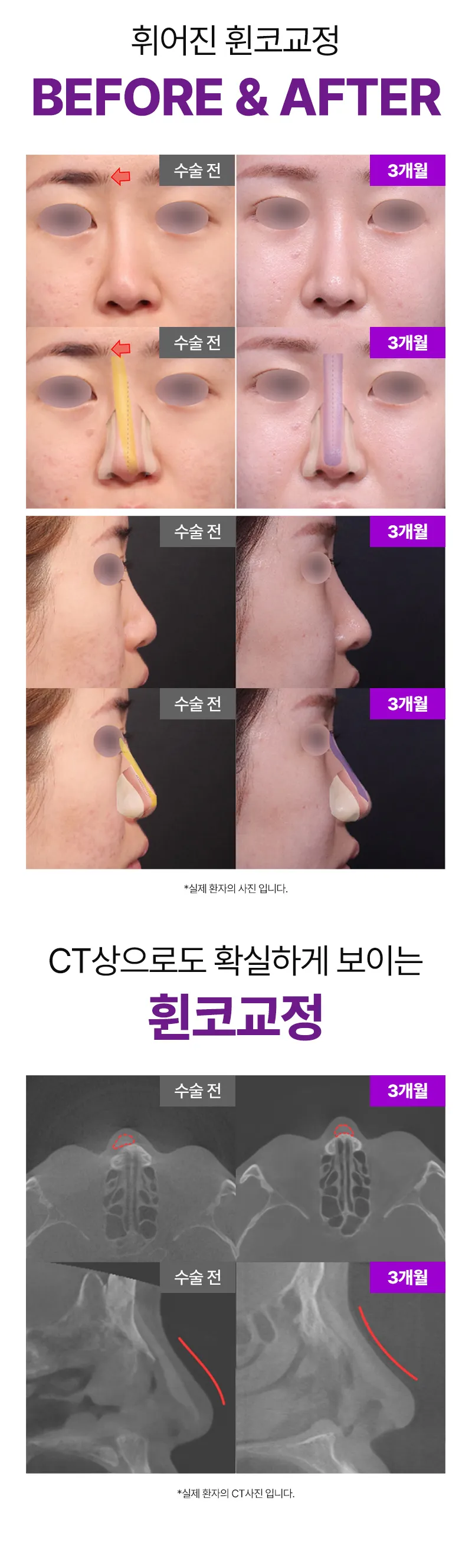 리터닝성형외과  리터닝3D핏미코맞춤보형물 이벤트, 시술 상세 이미지