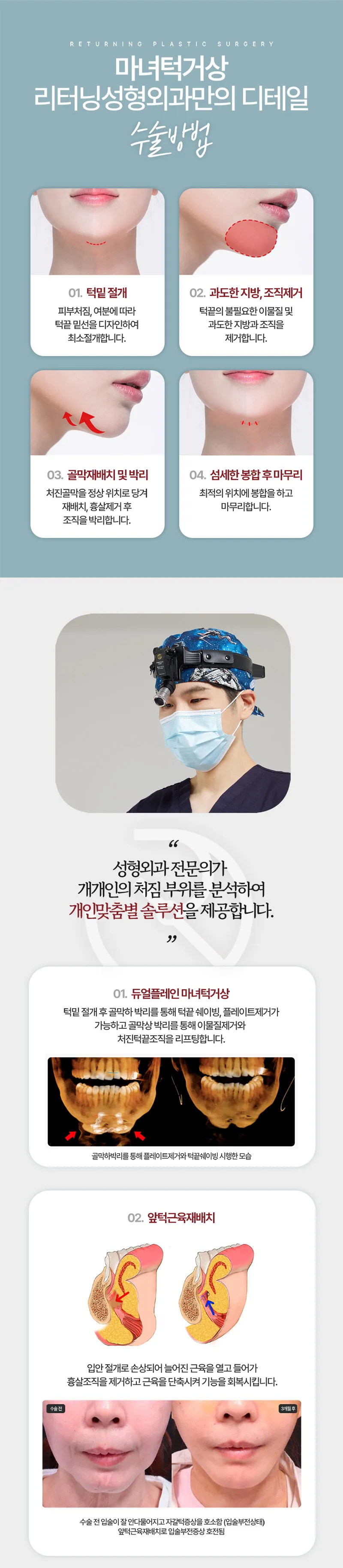 리터닝성형외과  리터닝 마녀턱거상 이벤트, 시술 상세 이미지