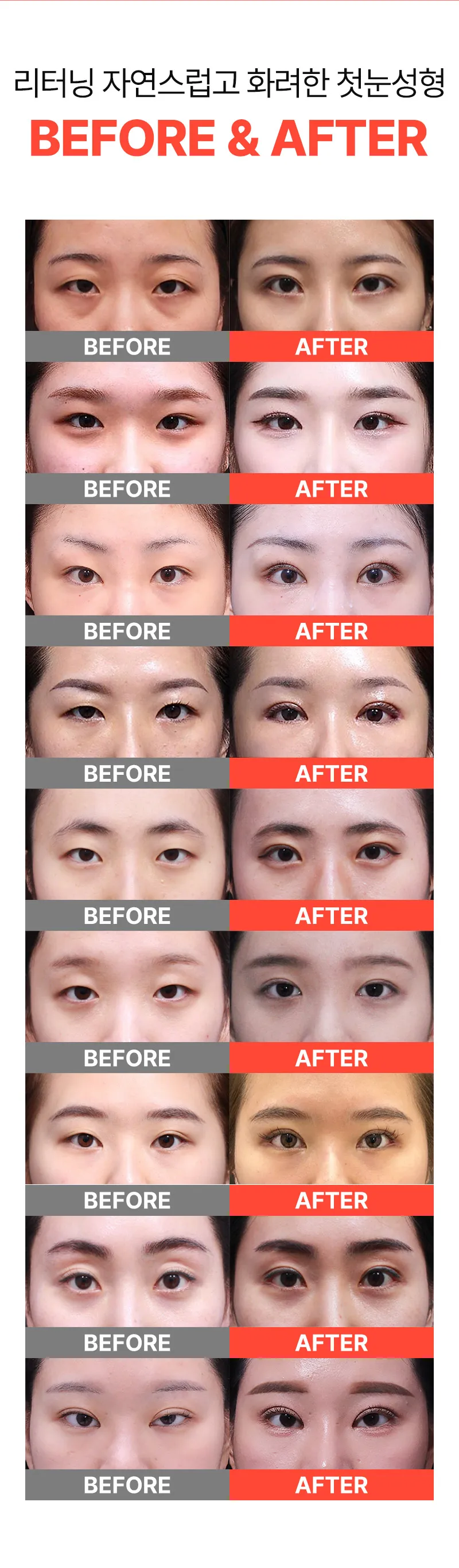 리터닝성형외과  리터닝 첫눈성형 이벤트, 시술 상세 이미지
