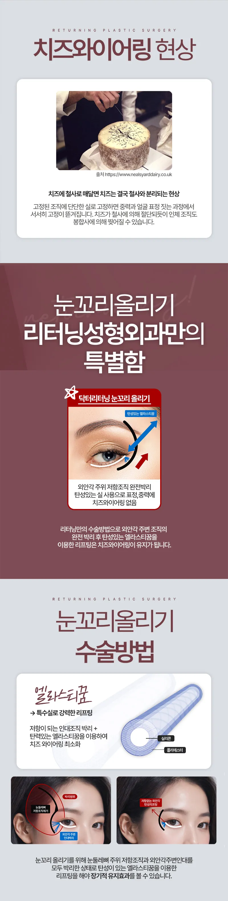 리터닝성형외과  리터닝눈꼬리올리기 여우눈 이벤트, 시술 상세 이미지