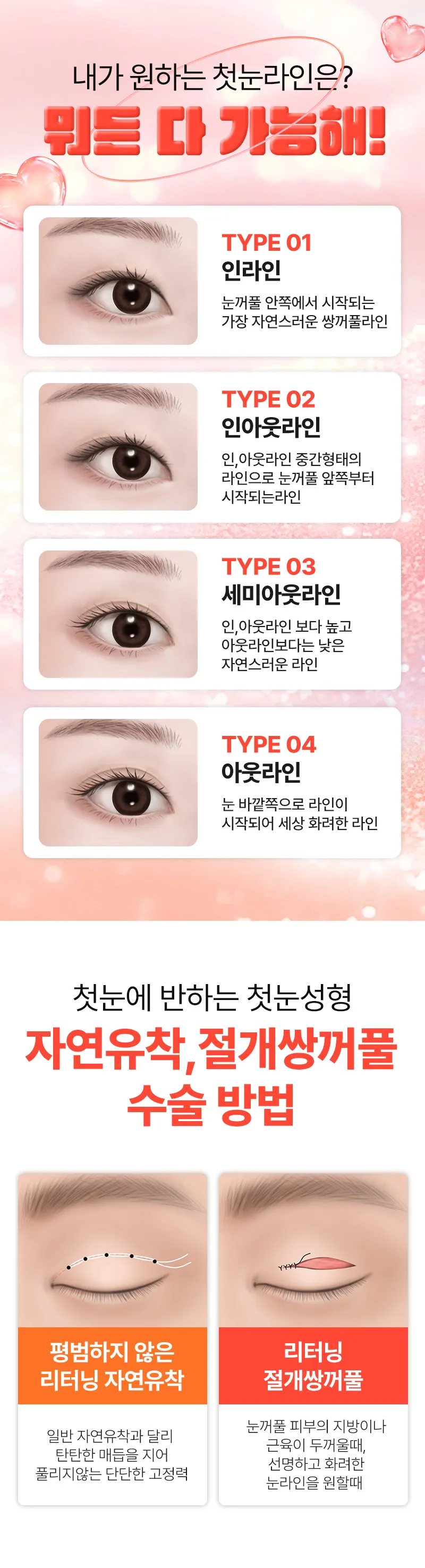 리터닝성형외과  리터닝 첫눈성형 이벤트, 시술 상세 이미지