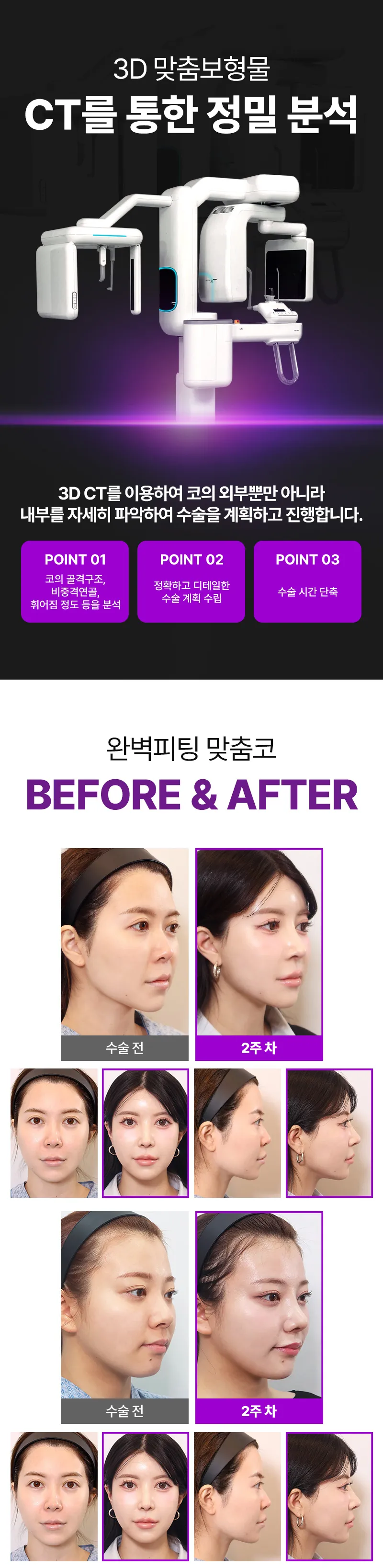 리터닝성형외과  리터닝3D핏미코맞춤보형물 이벤트, 시술 상세 이미지