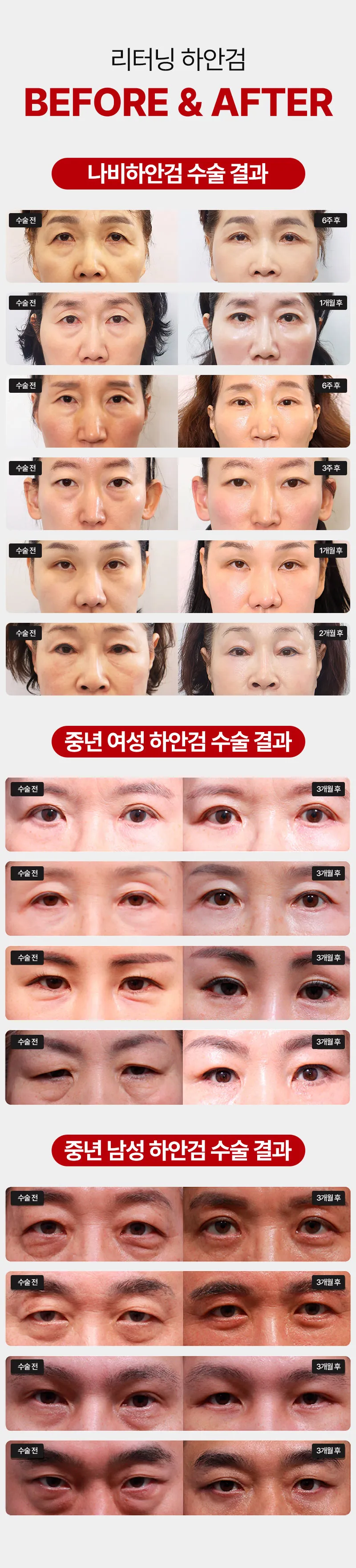리터닝성형외과 리터닝 하안검 이벤트, 시술 상세 이미지