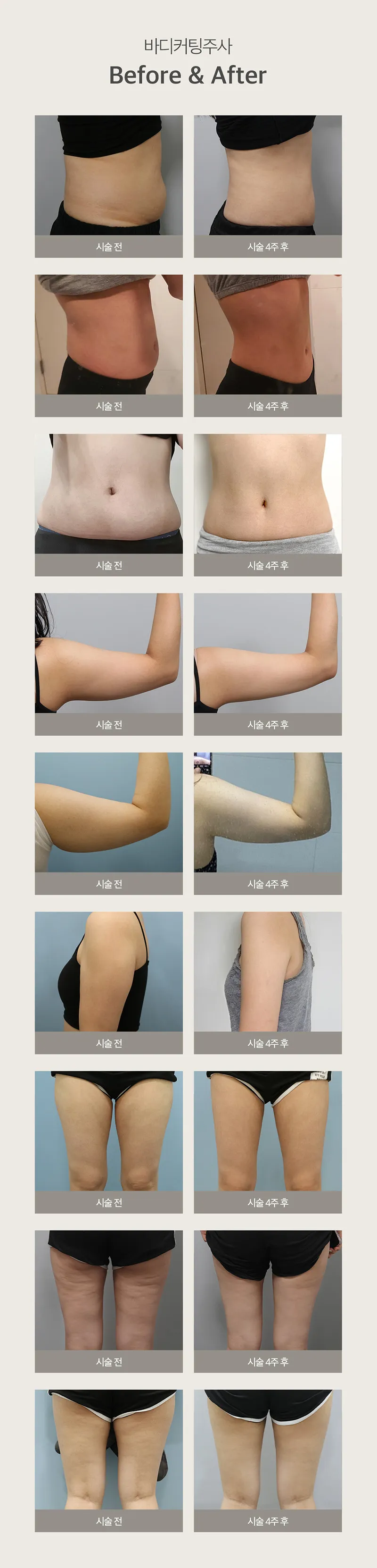 제이필의원 스테로이드 없는 강력 지방분해 커팅주 이벤트, 시술 상세 이미지