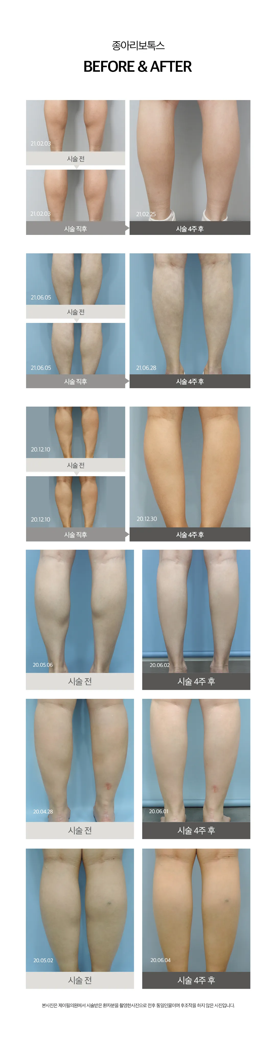 제이필의원 날씬한 종아리로 자신감 회복 이벤트, 시술 상세 이미지