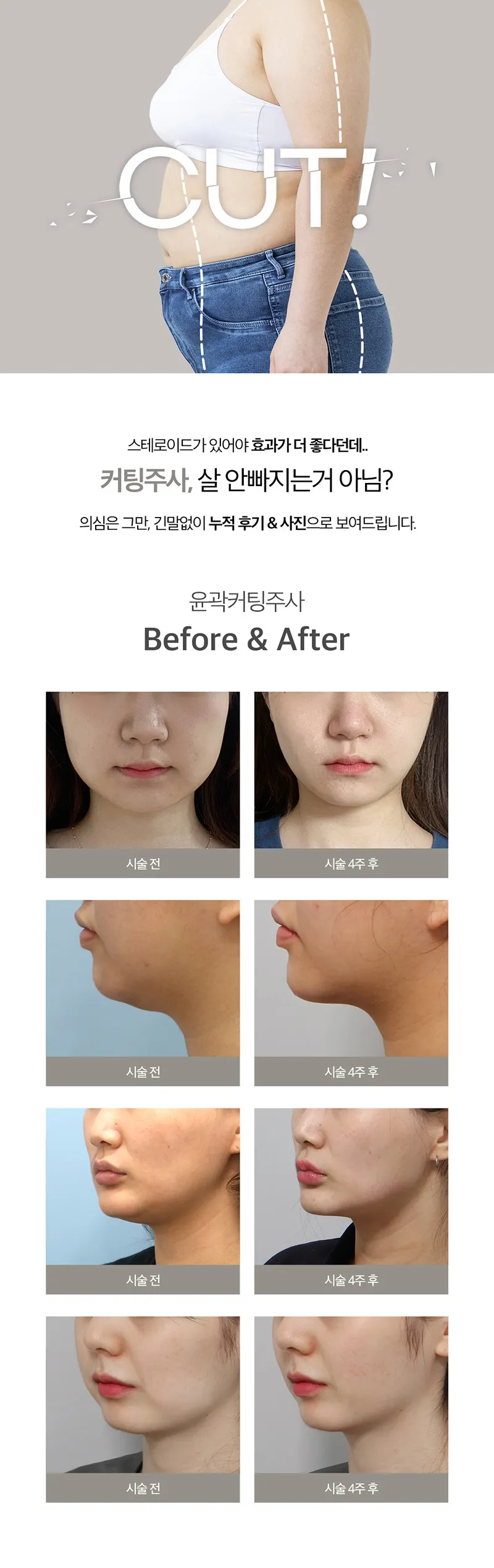 제이필의원 스테로이드 없는 강력 지방분해 커팅주 이벤트, 시술 상세 이미지