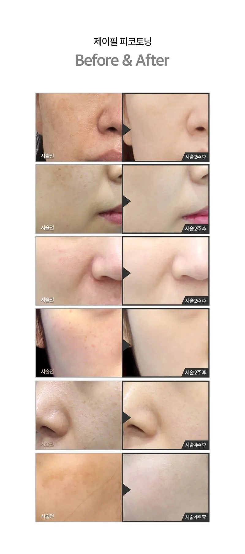 제이필의원 색소침착 치료엔 피코토닝 이벤트, 시술 상세 이미지