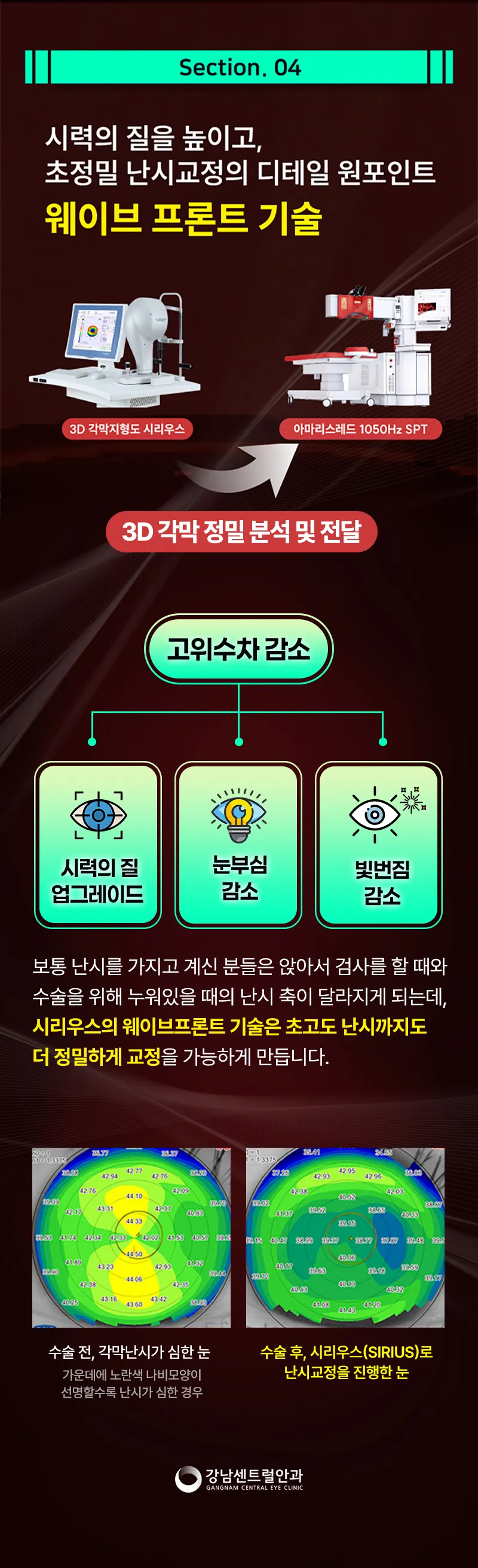 강남센트럴안과의원 단, 1.5일 회복, 원포인트 라섹 이벤트, 시술 상세 이미지