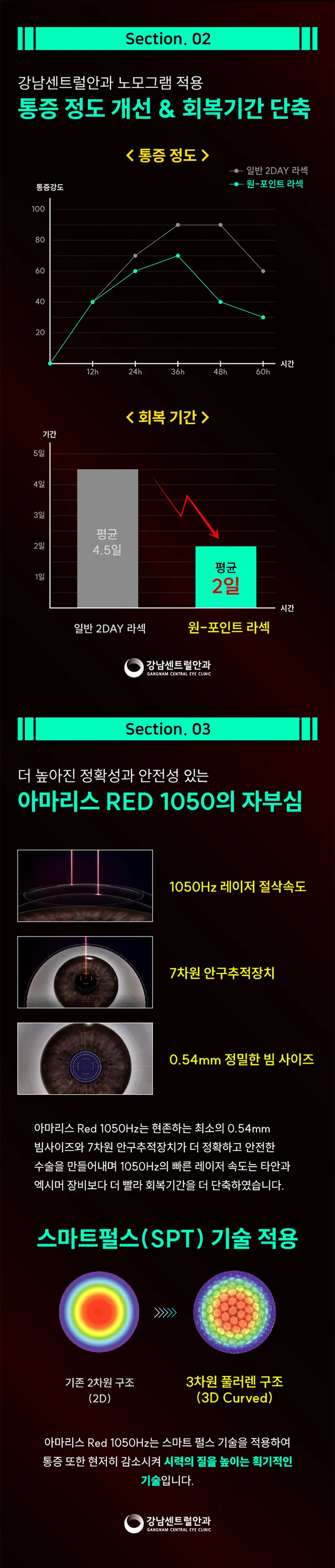 강남센트럴안과의원 단, 1.5일 회복, 원포인트 라섹 이벤트, 시술 상세 이미지