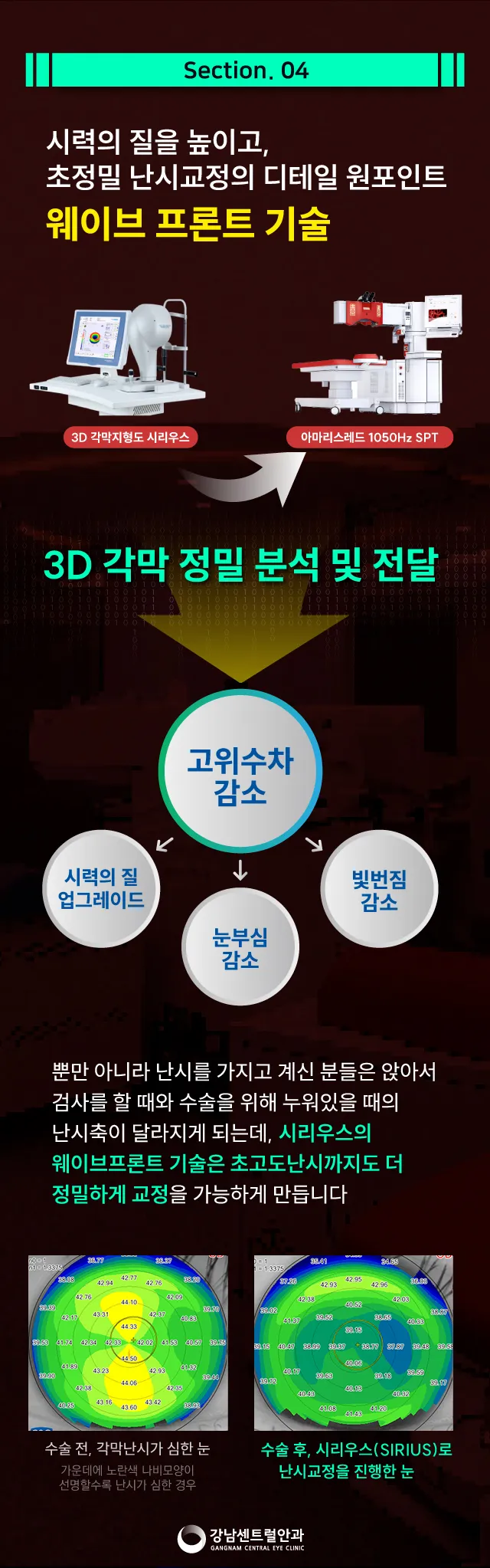 강남센트럴안과의원 단, 1.5일 회복, 원포인트 라섹 이벤트, 시술 상세 이미지