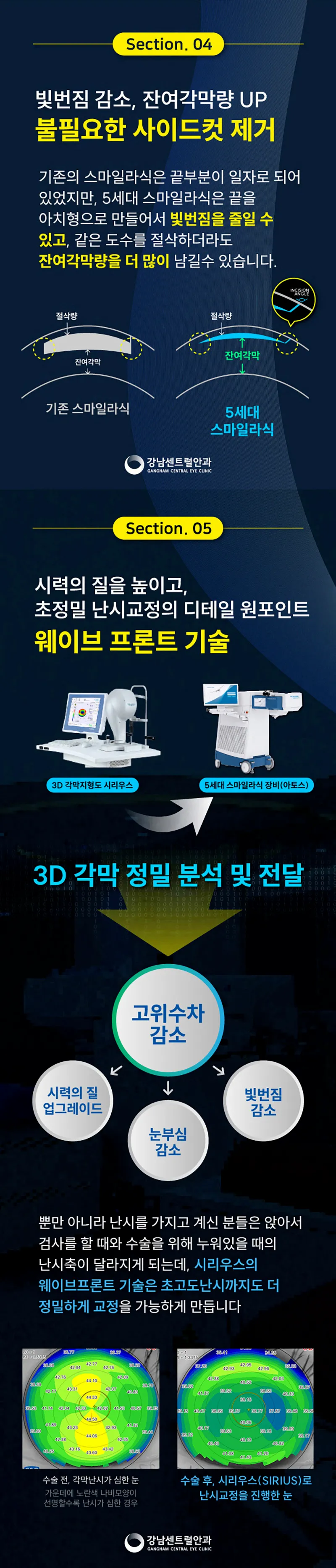 강남센트럴안과의원 특별가, 5세대 스마일라식, 라섹 이벤트, 시술 상세 이미지