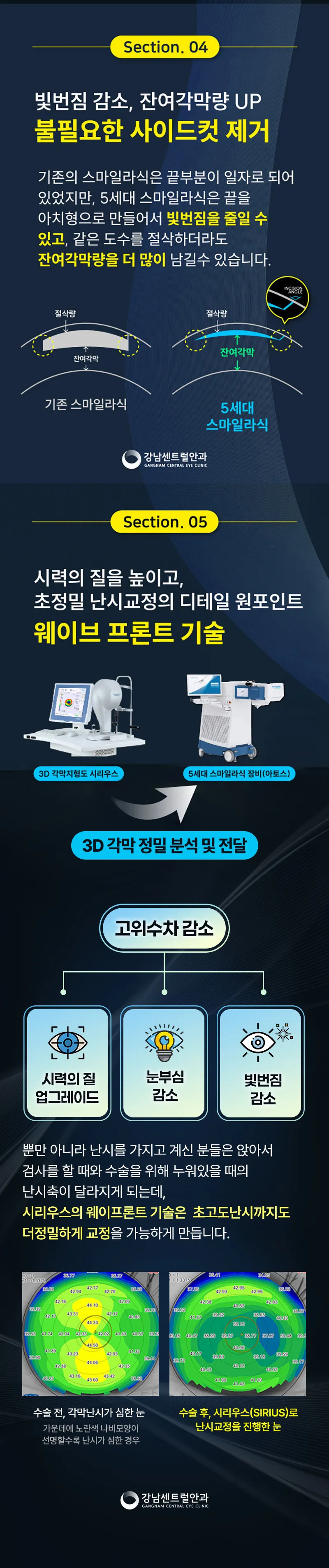 강남센트럴안과의원 개인 맞춤형 5세대 스마트 스마일라식 이벤트, 시술 상세 이미지
