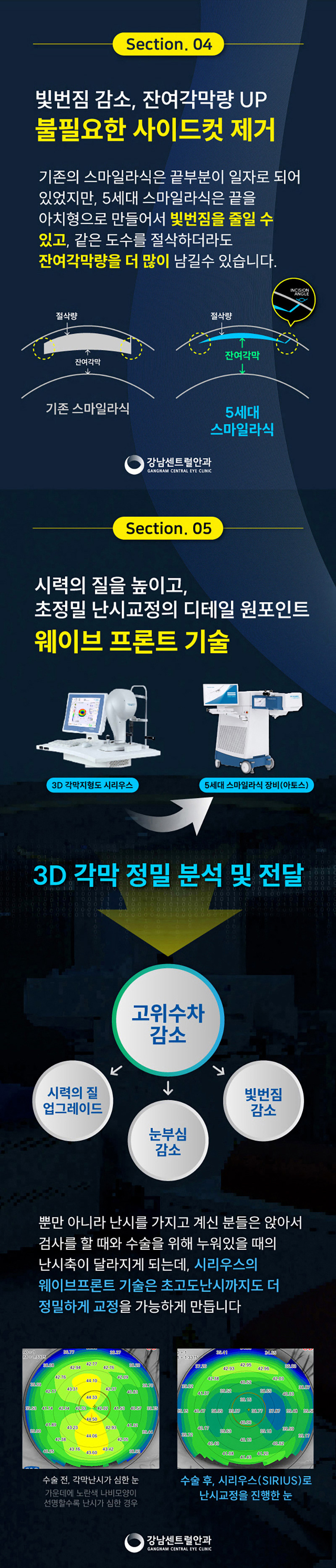 강남센트럴안과의원 추석특가, 5세대 스마일라식, 라섹 이벤트, 시술 상세 이미지