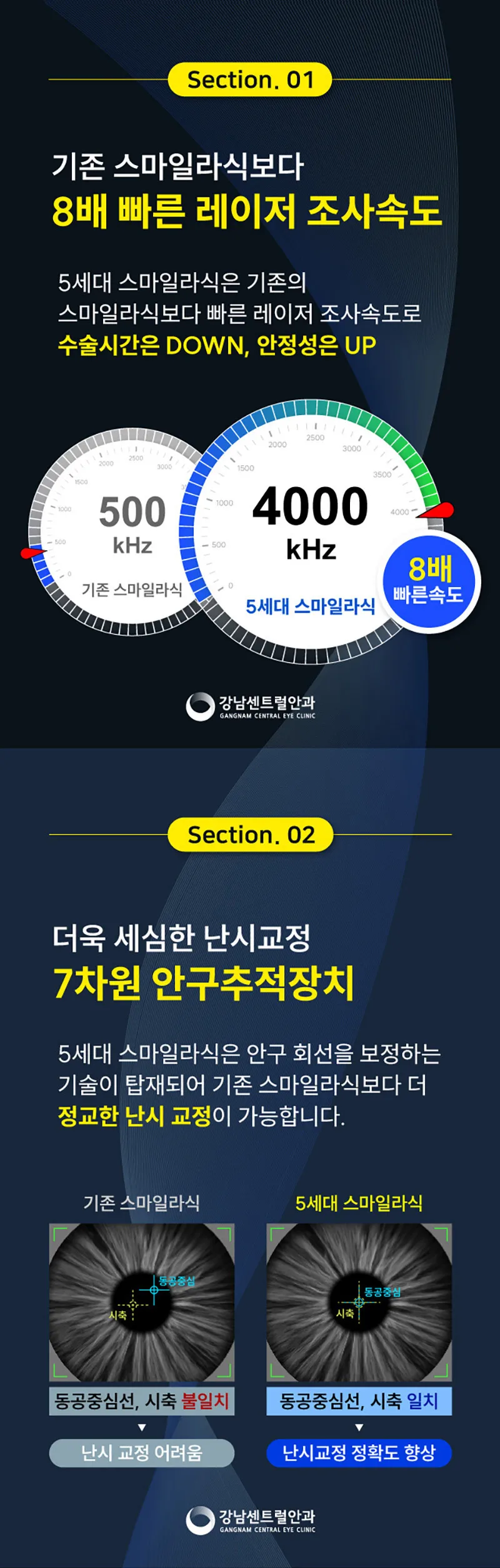 강남센트럴안과의원 개인 맞춤형 5세대 스마트 스마일라식 이벤트, 시술 상세 이미지