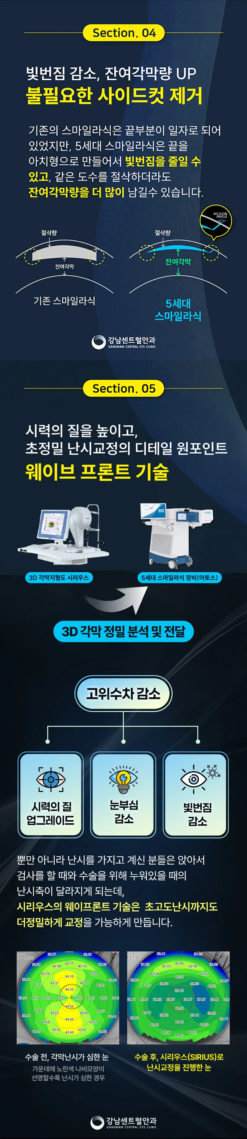강남센트럴안과의원 특별가, 5세대 스마일라식, 라섹 이벤트, 시술 상세 이미지