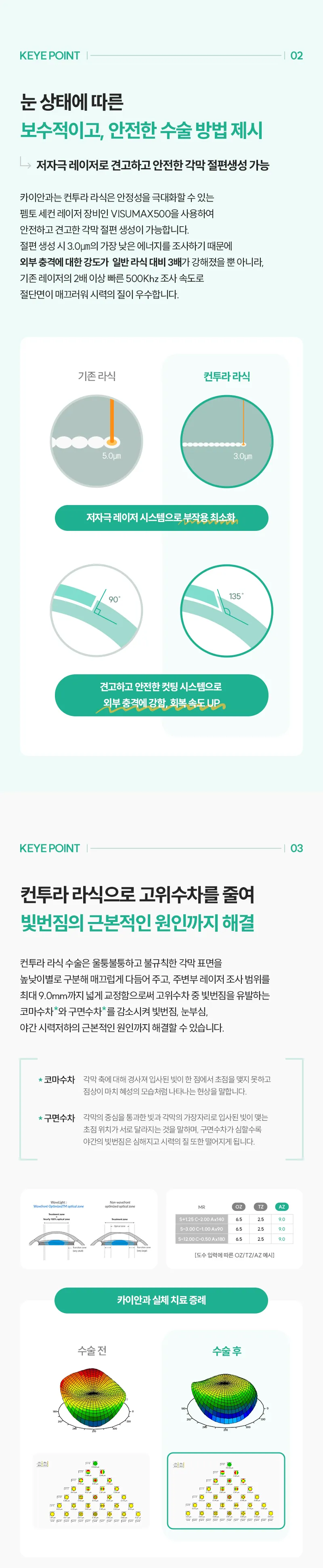 카이안과 개인 맞춤형 컨투라라식 특별할인 이벤트, 시술 상세 이미지