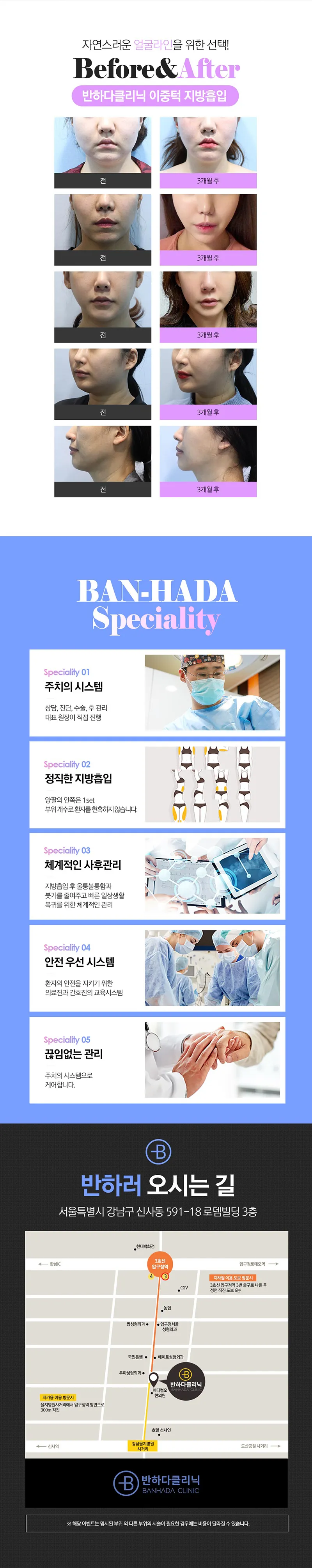 반하다의원 갸름한얼굴 이중턱지방흡입 이벤트, 시술 상세 이미지