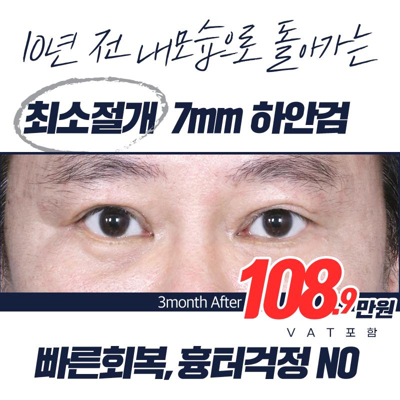 최소절개_7mm 하안검 이벤트 썸네일 이미지