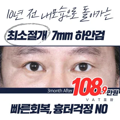 최소절개_7mm 하안검 이벤트 썸네일 이미지