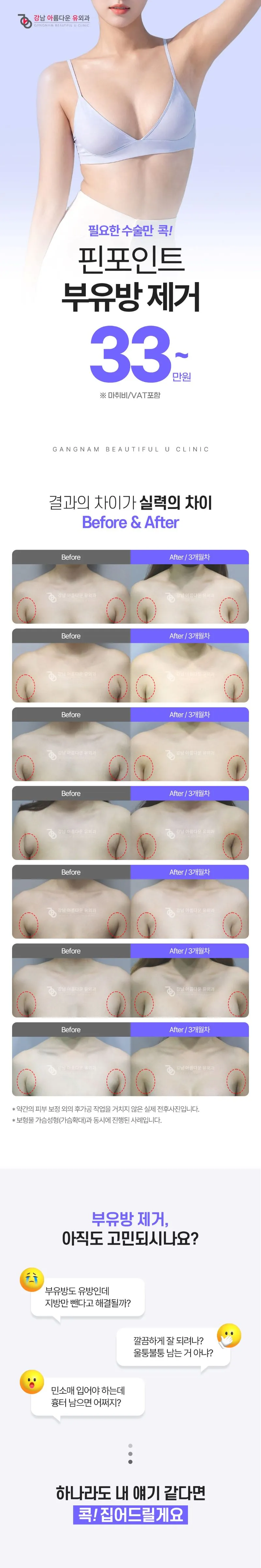 강남아름다운유외과의원 겨드랑이 부유방 핀포인트 제거 이벤트, 시술 상세 이미지