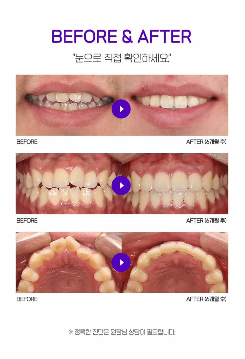 연세바로치과의원 압구정점 연세바로-앞니급속교정 이벤트, 시술 상세 이미지