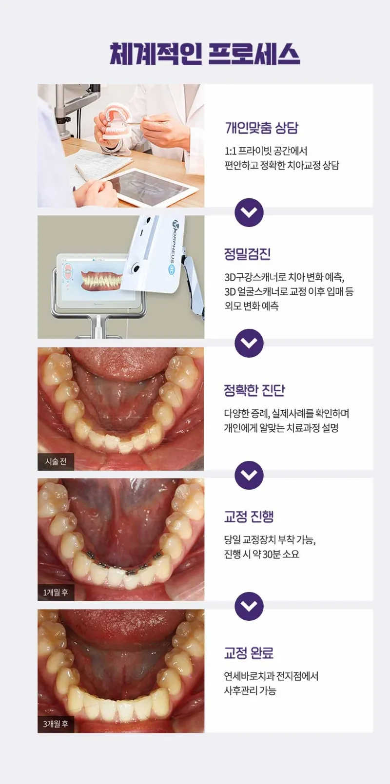 연세바로치과의원 압구정점 연세바로-앞니급속교정 이벤트, 시술 상세 이미지