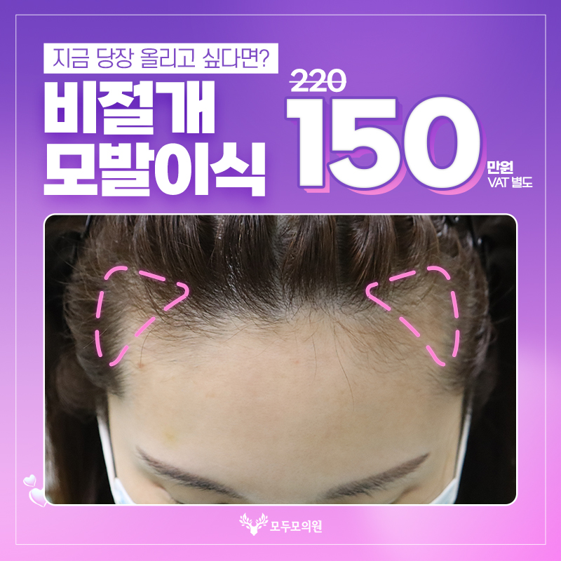대구 비절개모발이식 이벤트 썸네일 이미지