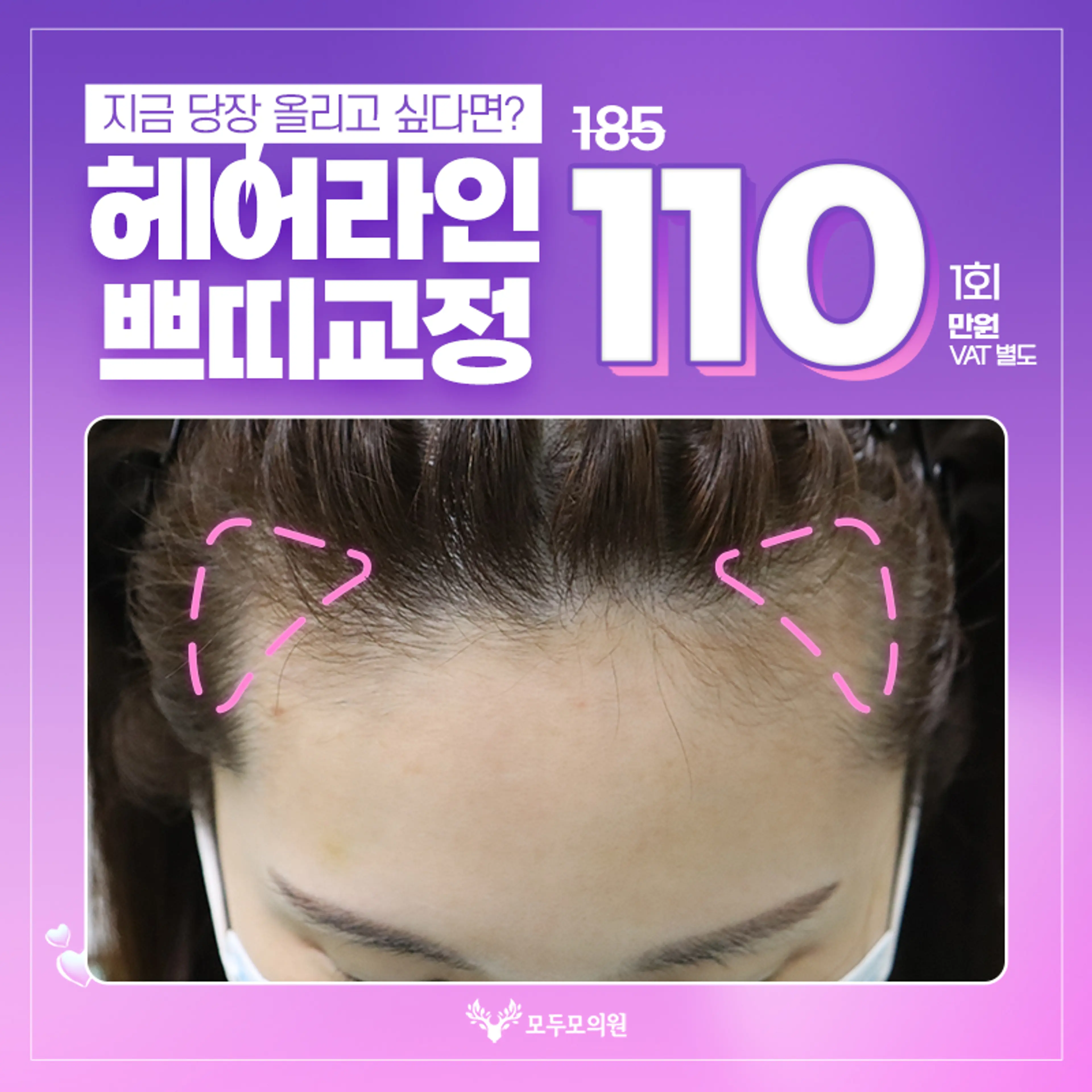 비절개모발이식