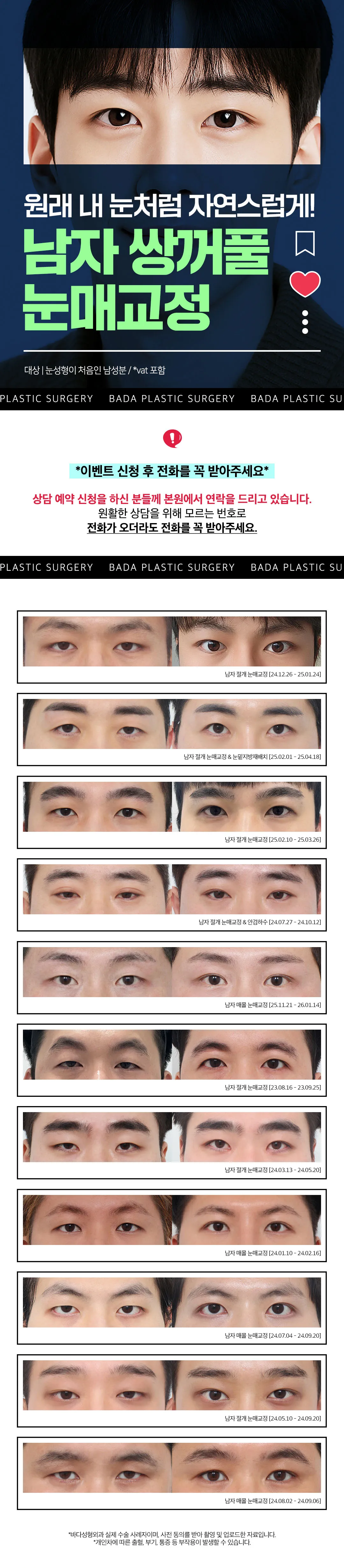 바다성형외과의원 남자 눈매교정 자연스러운 쌍꺼풀 라인 이벤트, 시술 상세 이미지
