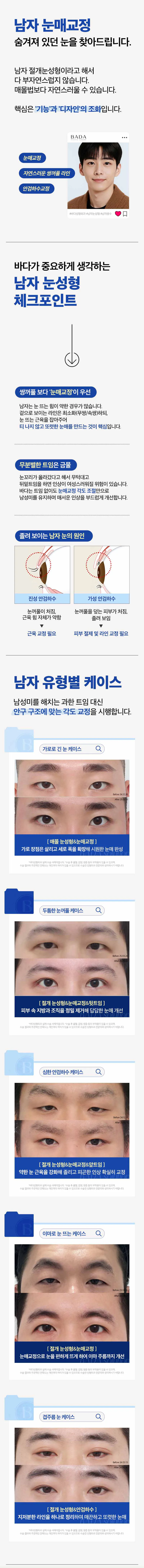 첫눈성형 쌍수_매몰, 절개, 눈매교정, 트임