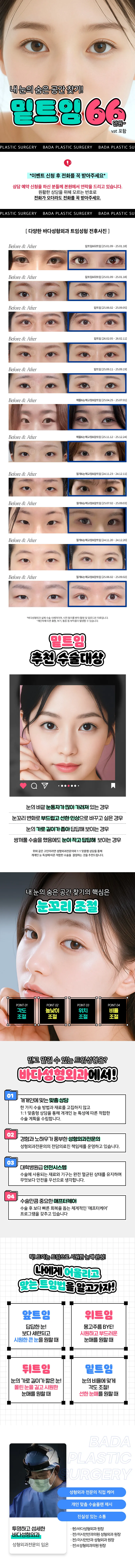 눈매확장 트임성형_밑트임
