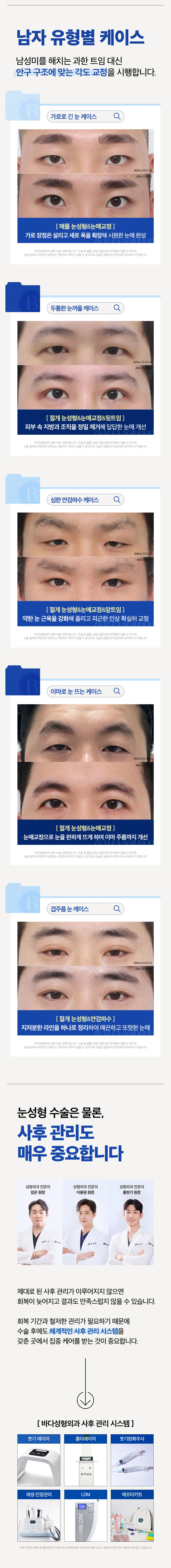 바다성형외과의원 남자 눈매교정 자연스러운 쌍꺼풀 라인 이벤트, 시술 상세 이미지