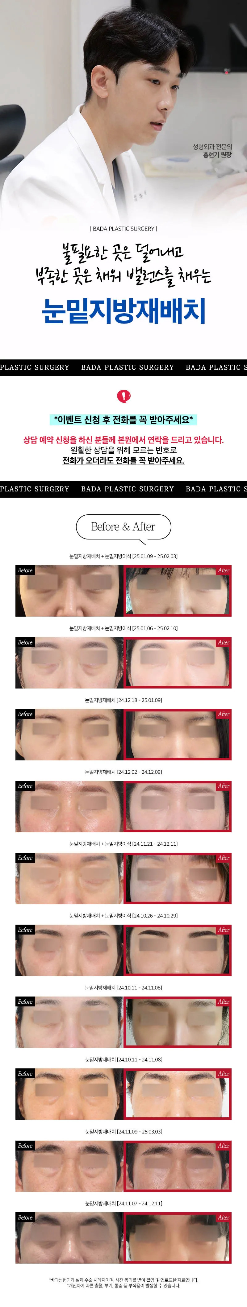 부산서면 눈밑지방재배치_눈밑꺼짐&돌출 고민별 맞춤솔루션