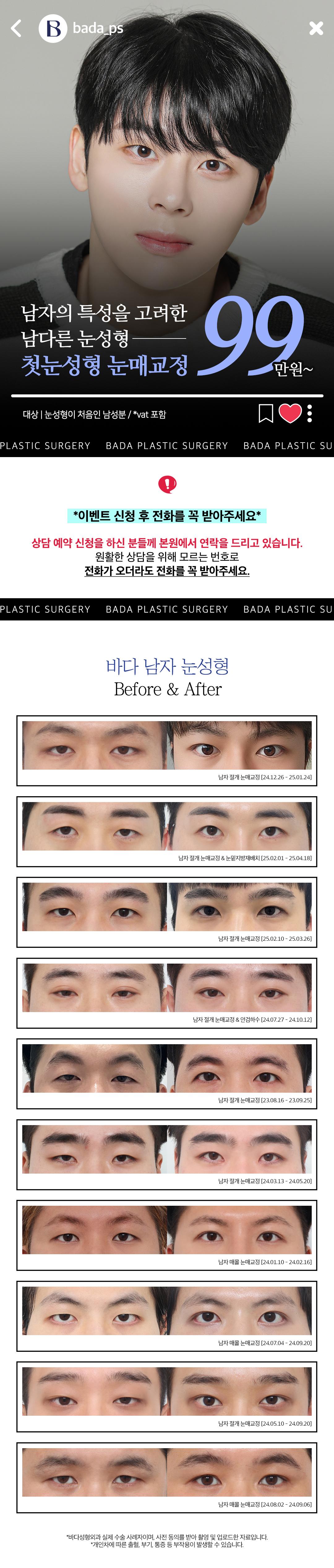 바다성형외과의원 남자 눈매교정 자연스러운 쌍꺼풀 라인 이벤트, 시술 상세 이미지