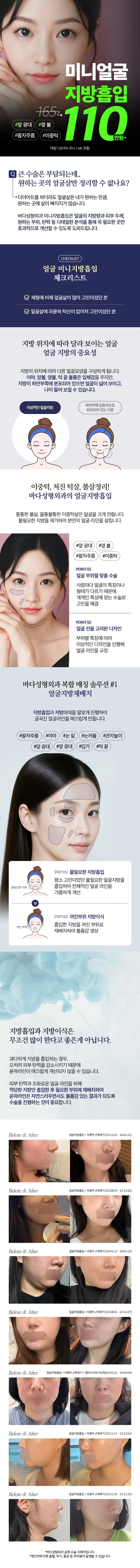 바다성형외과의원 v라인 미니 얼굴지방흡입 이벤트, 시술 상세 이미지