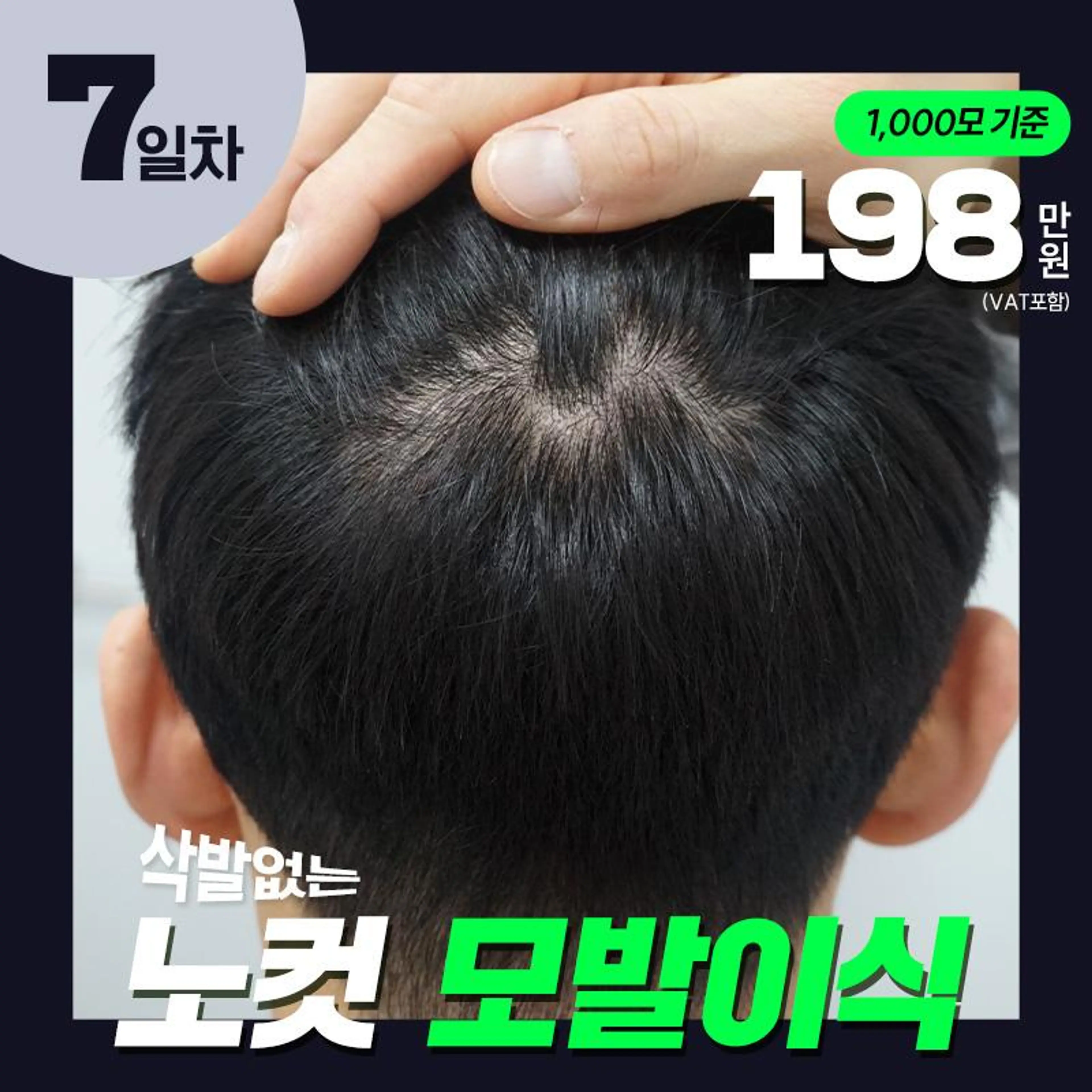 모발이식 노컷 1000모