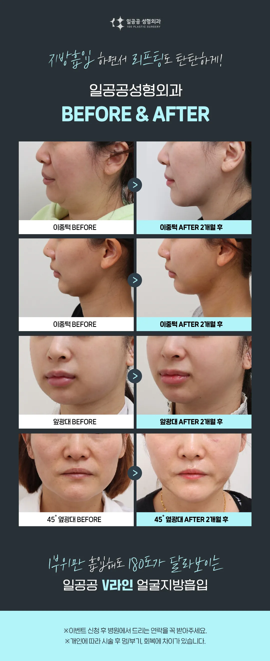 일공공성형외과의원 V라인 얼굴지방흡입 이벤트, 시술 상세 이미지