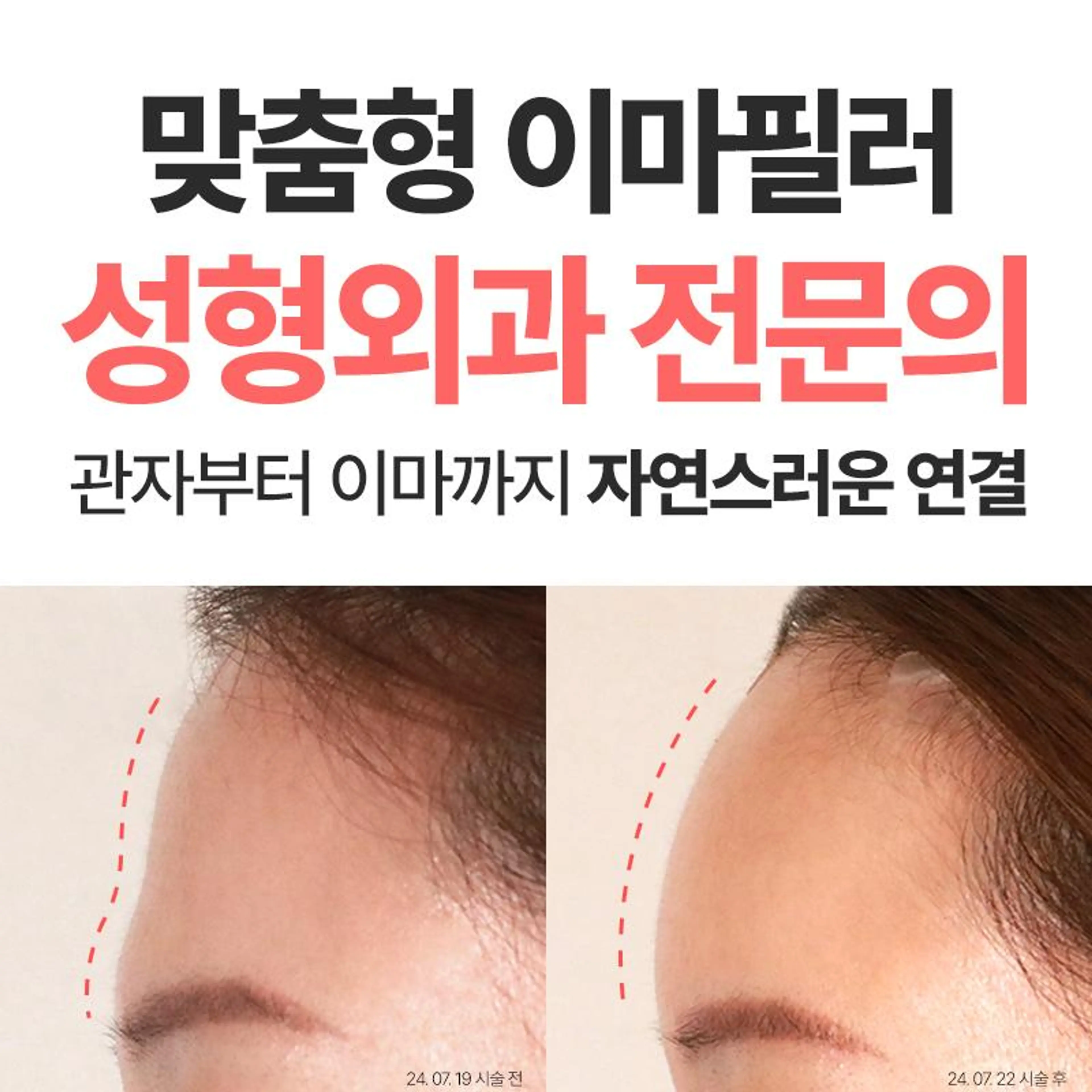 맞춤형 이마필러 4cc