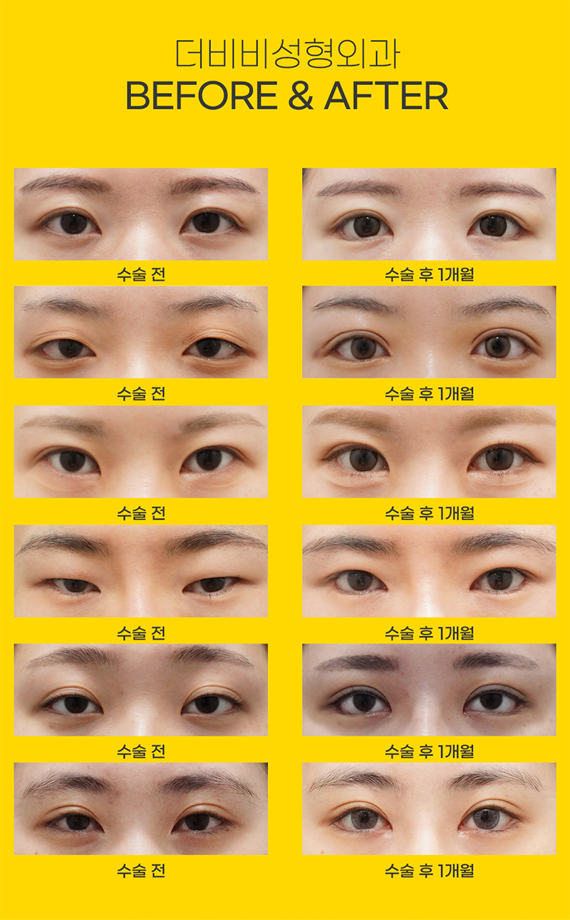 더비비성형외과의원 더비비 꾸안꾸트임 이벤트, 시술 상세 이미지