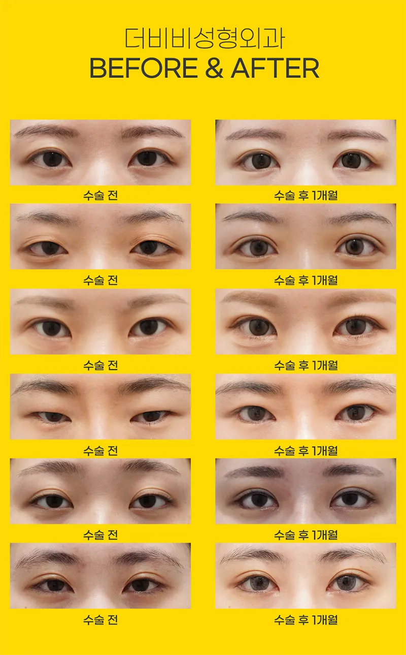 더비비성형외과의원 더비비 꾸안꾸트임 이벤트, 시술 상세 이미지