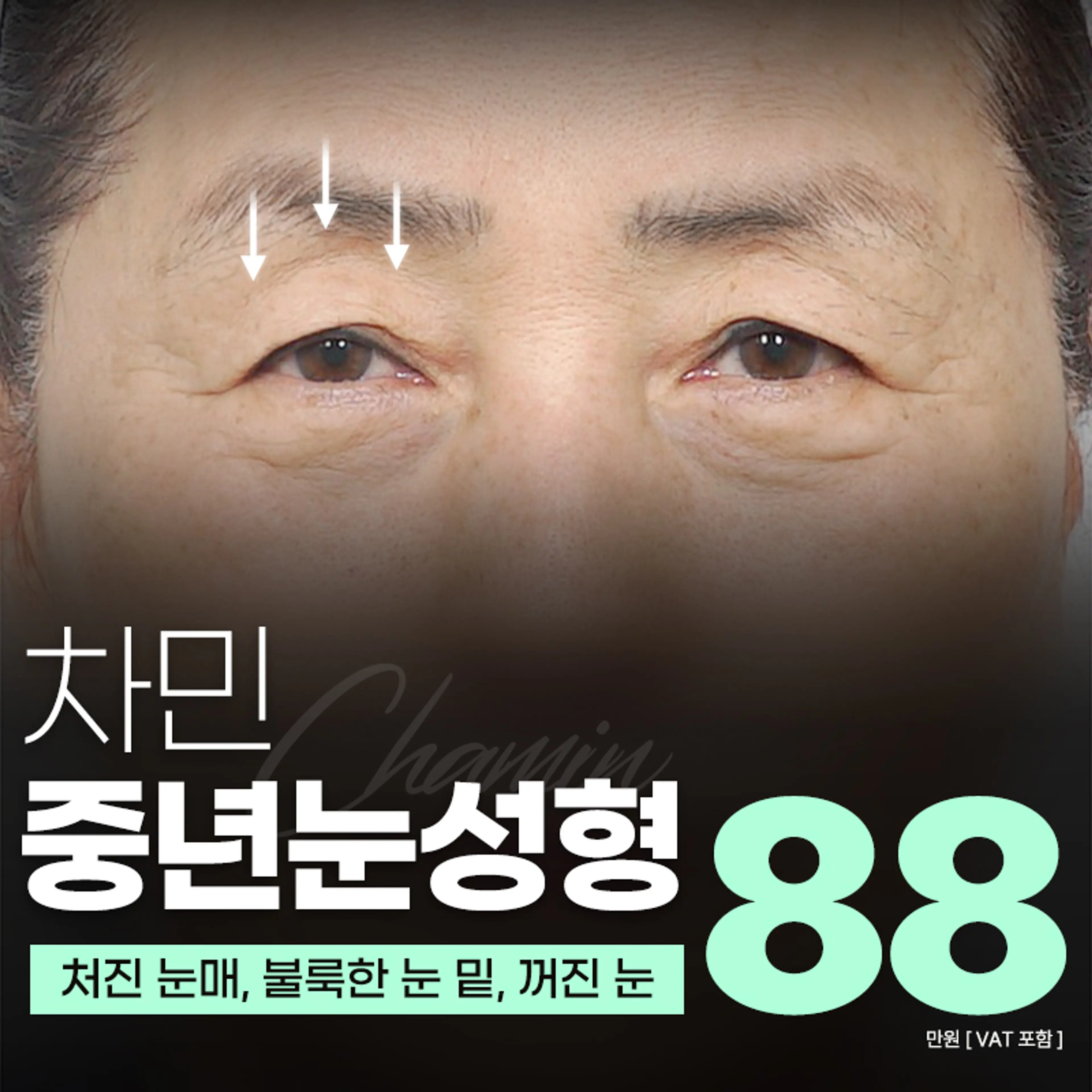 차민 중년눈성형